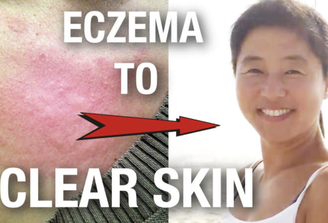 eczema to clear skin